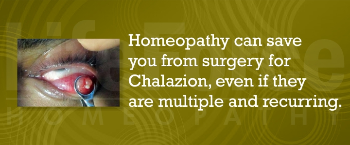 Homeopathic treatment for chalazion